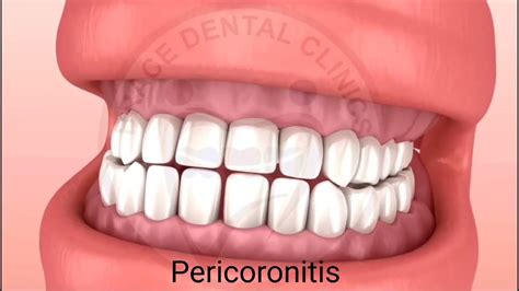 What Is Pericoronitis When Is Operculectomy Brace Dental Clinics