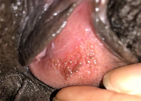 I Have Noticed These Bump Type Things On My Vulva They Itch Sometimes