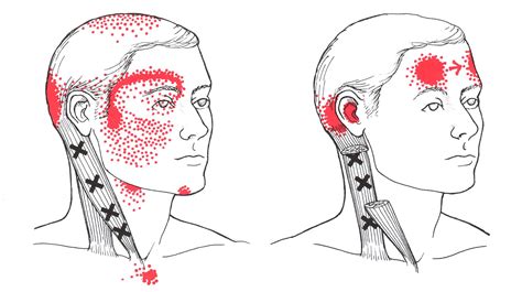 Sternocleidomastoid Trigger Points