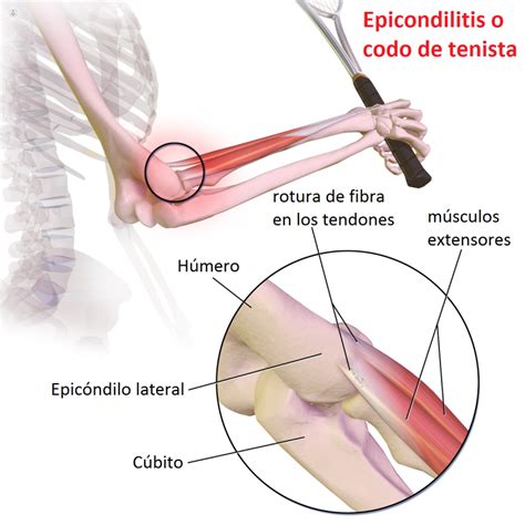 Qué es la epicondilitis o codo de tenista Top Doctors