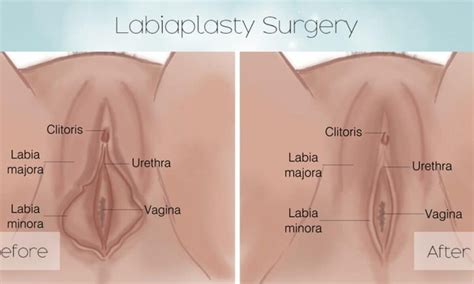 Labiaplasty Before And After