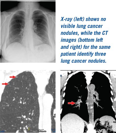 Can Chest Ct Scan Detect Breast Cancer Ct Scan Catches Of Lung My Xxx Hot Girl