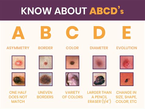 Different Types Of Skin Cancer Treatments