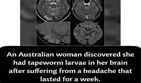 Doctors Find Tapeworm Larvae In A Womans Head After She Complains Of