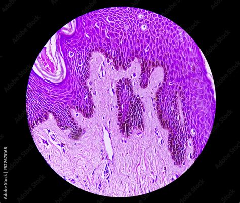 Histological Biopsy Of Scrotal Wall Under Microscopy Showing Calcinosis