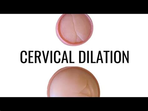 Cervical Dilation Up Close Youtube