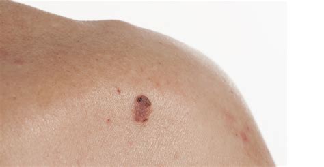 Basal Cell Carcinoma Skin And Laser Center Of Nj
