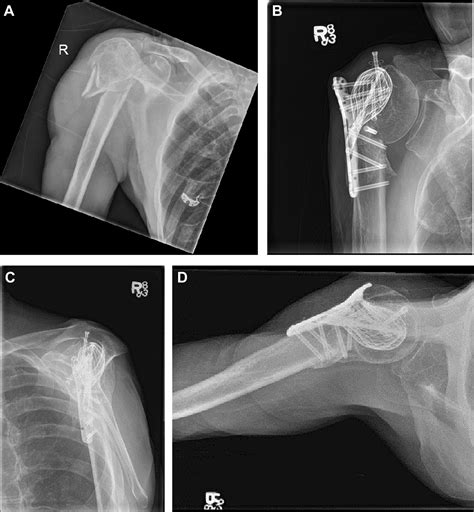 Three And Part Proximal Humeral Fracture Fixation With An