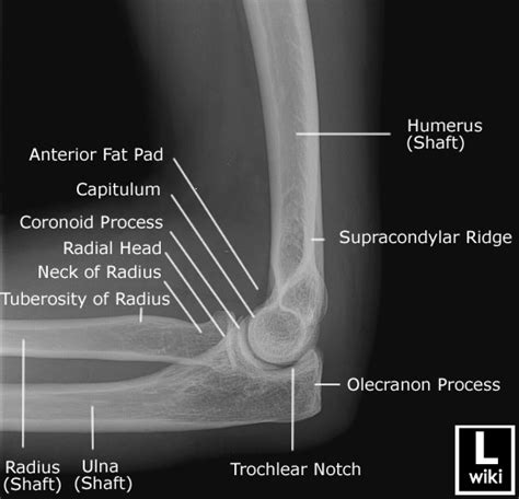Elbow Radiographic Anatomy Wikiradiography