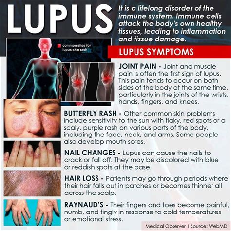 Timeline Photos Medical Observer Facebook Lupus