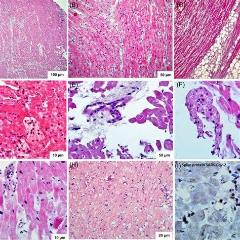 Endomyocardial Biopsy Of The Right Ventricle In Patients With