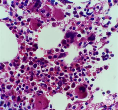 Immune Thrombocytopenic Purpura Itp Bone Marrow Biopsy View 7