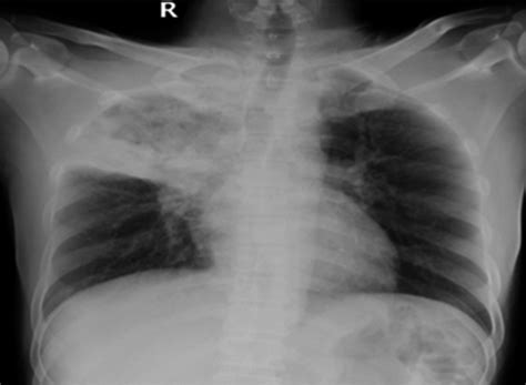Frontal Chest X‐ray Showing Lobar Consolidation Of The Right Upper Lobe