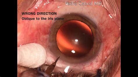 Accessory Incision Paracentesis For Cataract Surgery Step By Step