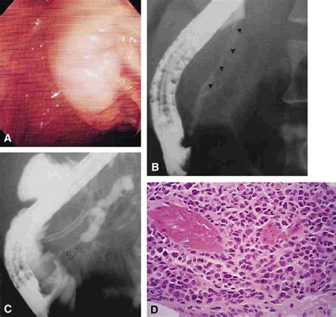Primary Lymphoma Of The Major Duodenal Papilla Gastrointestinal Endoscopy