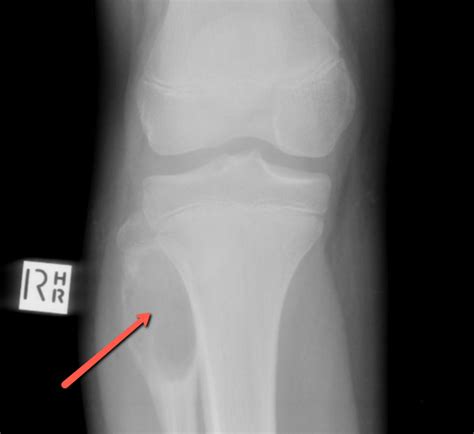 Aneurysmal Bone Cysts Ask Dr P The Pain Doc