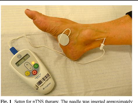 Percutaneous Tibial Nerve Stimulation Ptns Success Rate And The Role