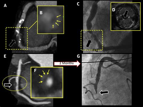 Coronary Ct Angiography Identification Of Patients And Plaques “at