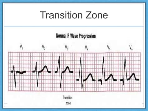 Normal Ecg Interpretation