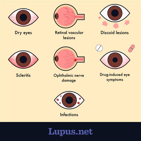 How Does Lupus Affect The Eyes