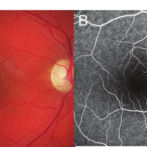 A Fundus Photograph A And Fluorescein Angiogram B Of The Left Eye