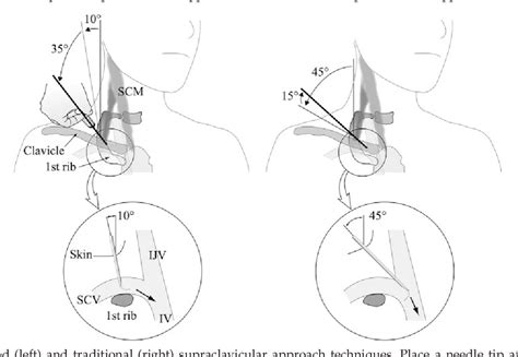 Figure 2 From A Novel Supraclavicular Approach To The Right Subclavian