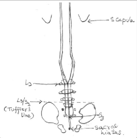 Anatomical Landmarks For Pediatric Spinal Download Scientific Diagram