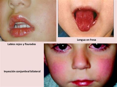 • imunoglobulina humana na dosagem de 2,0 g/kg em 12 horas; ENFERMEDAD DE KAWASAKI - PAUTA DE MANEJO, TRATAMIENTO Y ...