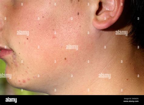Mumps Swollen Gland Of A 14 Year Old Boy With Mumps Parotitis A Viral