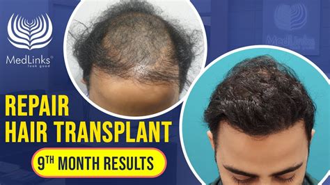 Results Of Repair Hair Transplant After Months Best Hair Transplant