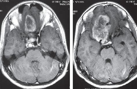 Mri Brain Axial View Showing Skull Base Meningioma Download