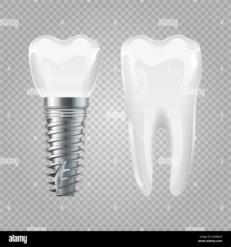Implante Dental Diente Sano Realista E Implante Elementos De Cirugía
