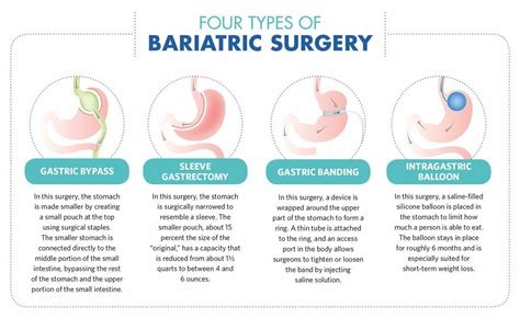 How To Choose The Best Type Of Bariatric Surgery Women Fitness Mag Bariatric Surgery