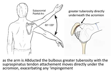 Rotator Cuff Supraspinatus Tendonitis Treatment Cambridge Shoulder