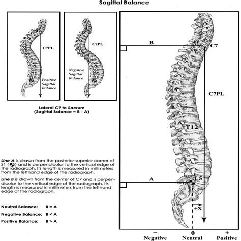 The Impact Of Positive Sagittal Balance In Adult Spinal Defo Spine