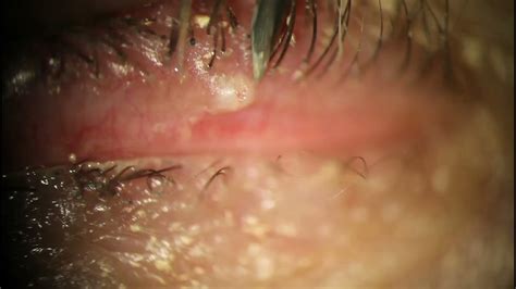 Cysts Cut Out Of Both Eyelids One Liquid And One Explosive Solid