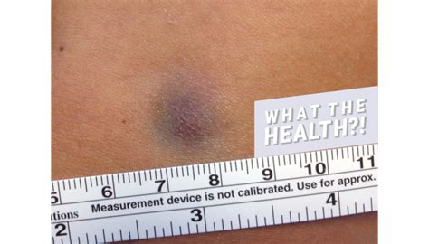 This Womans Tiny Bruise Turned Out To Be A Rare Form Of Skin Cancer