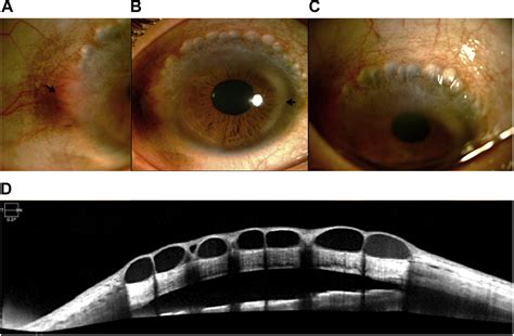Conjunctival Inclusion Cysts In Chronic Vernal Keratoconjunctivitis