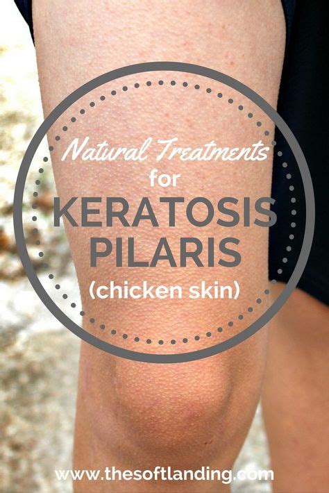 Soothe Keratosis Pilaris Chicken Skin With African Black Soap And