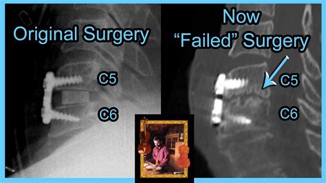 Failed Spine Surgery Acdf Surgery Again C5 C6 C7 Fusion And Recovery