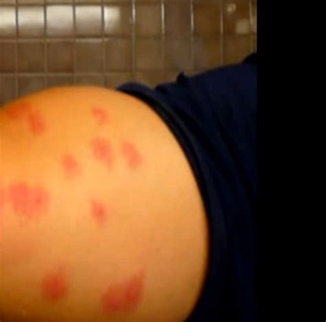Bed Bug Bites Pictures Symptoms Causes Treatment