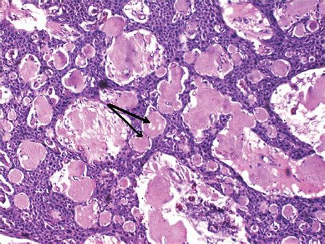 Giant Pindborg Tumor Calcifying Epithelial Odontogenic Tumor An