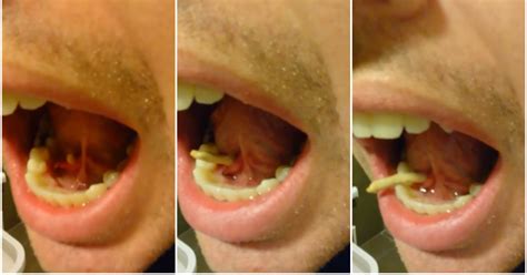 Watch This Man Push A Salivary Stone Out Of His Mouth And Be Changed