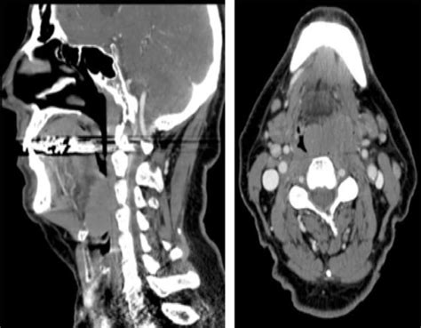 Sagittal And Axial Computed Tomography Of The Neck With Contrast
