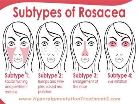 The Wardrobe Clinic Rosacea And The Types