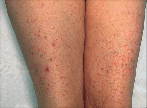 Lentigolike Macules And Erythematous Plaques On Trunk And Extremities