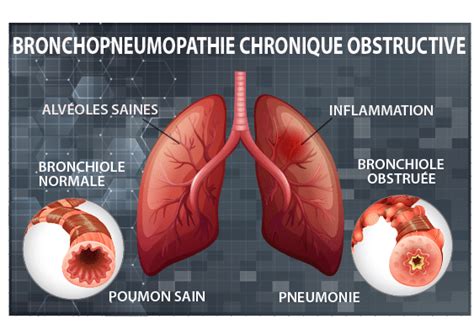 La Broncho Pneumopathie Chronique Obstructive Bpco Facteurs De