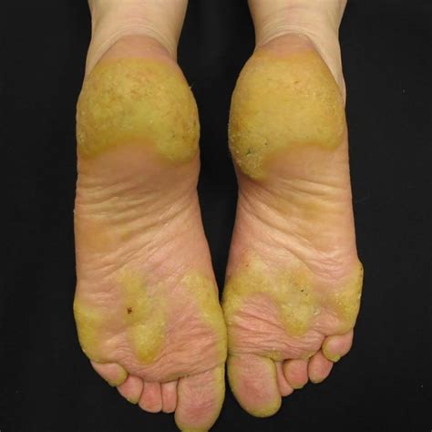 Keratosis On Feet Hot Sex Picture