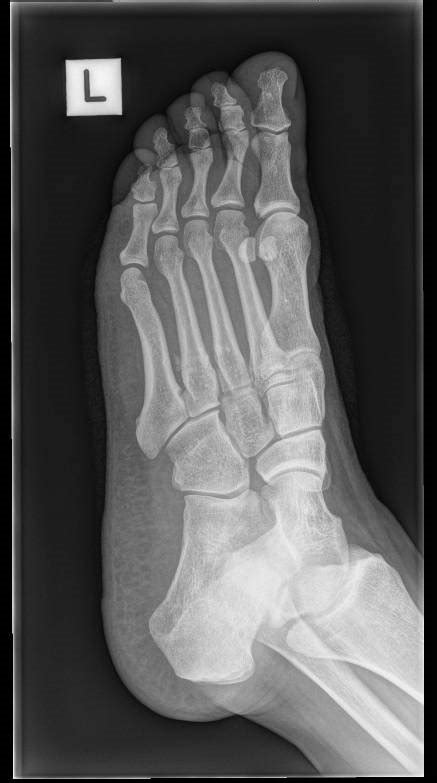 Lateral Oblique Foot X Ray Hot Sex Picture