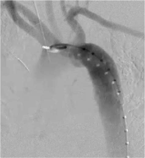 Aortic Arch Angiogram Demonstrating Grade Iii Blunt Traumatic Aortic
